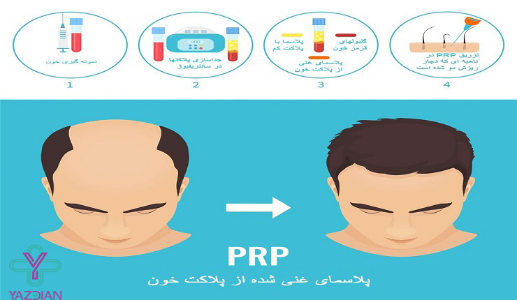 پی آر پی مو چیست؟برای چه کسانی مناسب است و چگونه عمل می‌کند